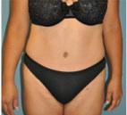 Tummy Tuck after at Dr. Michael J. Sundine | Facial Aesthetic & Facial Reconstructive Surgery in Newport Beach, CA