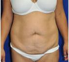 Tummy Tuck before at Dr. Michael J. Sundine | Facial Aesthetic & Facial Reconstructive Surgery in Newport Beach, CA
