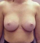 Dr. Michael J. Sundine | Facial Aesthetic & Facial Reconstructive Surgery breast augmentation after — Newport Beach, CA