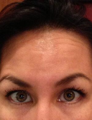 Botox after at Dr. Michael J. Sundine | Facial Aesthetic & Facial Reconstructive Surgery in Newport Beach, CA