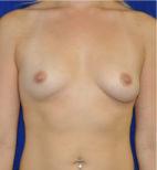 Breast Augmentation before at Dr. Michael J. Sundine | Facial Aesthetic & Facial Reconstructive Surgery in Newport Beach, CA