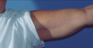 Arm Lift after at Dr. Michael J. Sundine | Facial Aesthetic & Facial Reconstructive Surgery in Newport Beach, CA