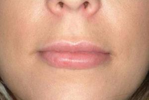 Lip Filler after at Dr. Michael J. Sundine | Facial Aesthetic & Facial Reconstructive Surgery in Newport Beach, CA