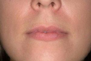 Lip Filler before at Dr. Michael J. Sundine | Facial Aesthetic & Facial Reconstructive Surgery in Newport Beach, CA