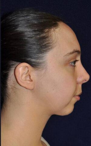 Neck Liposuction after at Dr. Michael J. Sundine | Facial Aesthetic & Facial Reconstructive Surgery in Newport Beach, CA