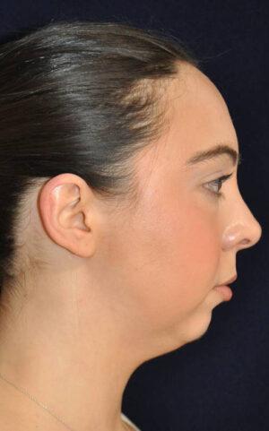 Neck Liposuction before at Dr. Michael J. Sundine | Facial Aesthetic & Facial Reconstructive Surgery in Newport Beach, CA