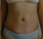 Tummy Tuck after at Dr. Michael J. Sundine | Facial Aesthetic & Facial Reconstructive Surgery in Newport Beach, CA