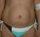 Tummy Tuck before at Dr. Michael J. Sundine | Facial Aesthetic & Facial Reconstructive Surgery in Newport Beach, CA