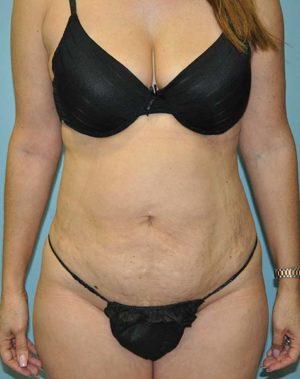 Liposuction after at Dr. Michael J. Sundine | Facial Aesthetic & Facial Reconstructive Surgery in Newport Beach, CA