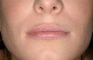 Lip Filler after at Dr. Michael J. Sundine | Facial Aesthetic & Facial Reconstructive Surgery in Newport Beach, CA