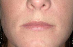 Lip Filler before at Dr. Michael J. Sundine | Facial Aesthetic & Facial Reconstructive Surgery in Newport Beach, CA