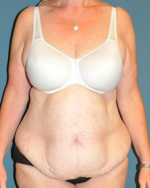 Tummy Tuck before at Dr. Michael J. Sundine | Facial Aesthetic & Facial Reconstructive Surgery in Newport Beach, CA
