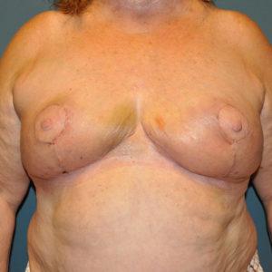 Breast Reduction after at Dr. Michael J. Sundine | Facial Aesthetic & Facial Reconstructive Surgery in Newport Beach, CA