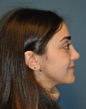 Rhinoplasty after at Dr. Michael J. Sundine | Facial Aesthetic & Facial Reconstructive Surgery in Newport Beach, CA