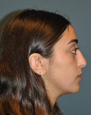 Rhinoplasty before at Dr. Michael J. Sundine | Facial Aesthetic & Facial Reconstructive Surgery in Newport Beach, CA
