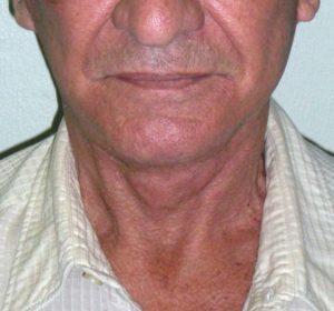 Neck Lift after at Dr. Michael J. Sundine | Facial Aesthetic & Facial Reconstructive Surgery in Newport Beach, CA