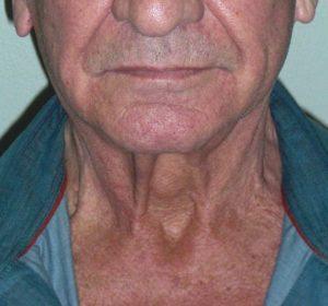 Neck Lift before at Dr. Michael J. Sundine | Facial Aesthetic & Facial Reconstructive Surgery in Newport Beach, CA