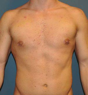 Gynecomastia Surgery after at Dr. Michael J. Sundine | Facial Aesthetic & Facial Reconstructive Surgery in Newport Beach, CA