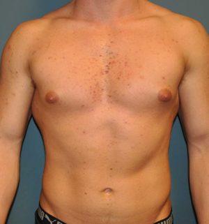 Gynecomastia Surgery before at Dr. Michael J. Sundine | Facial Aesthetic & Facial Reconstructive Surgery in Newport Beach, CA