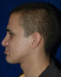 Rhinoplasty after at Dr. Michael J. Sundine | Facial Aesthetic & Facial Reconstructive Surgery in Newport Beach, CA