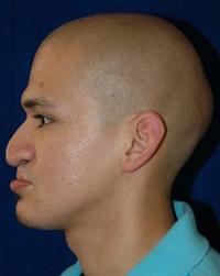 Rhinoplasty before at Dr. Michael J. Sundine | Facial Aesthetic & Facial Reconstructive Surgery in Newport Beach, CA