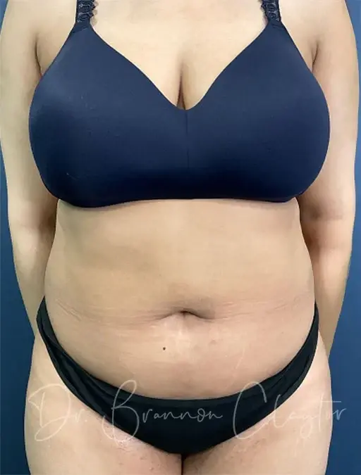 Liposuction before at Claytor Noone Plastic Surgery: Dr. R. Brannon Claytor in Bryn Mawr, PA