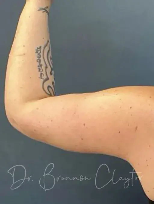 Arm Lift after at Claytor Noone Plastic Surgery: Dr. R. Brannon Claytor in Bryn Mawr, PA