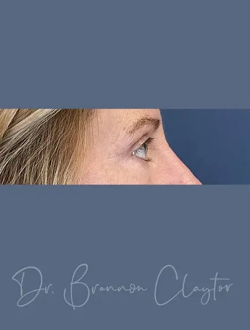 Blepharoplasty after at Claytor Noone Plastic Surgery: Dr. R. Brannon Claytor in Bryn Mawr, PA