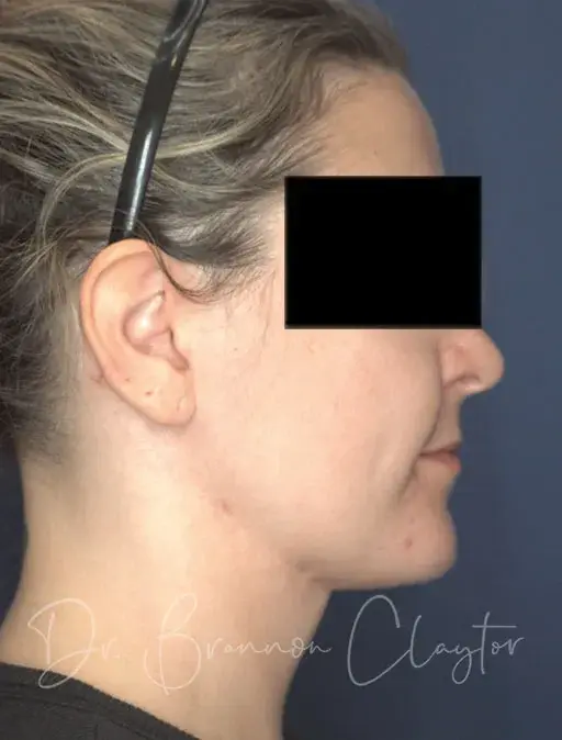 Neck Lift after at Claytor Noone Plastic Surgery: Dr. R. Brannon Claytor in Bryn Mawr, PA