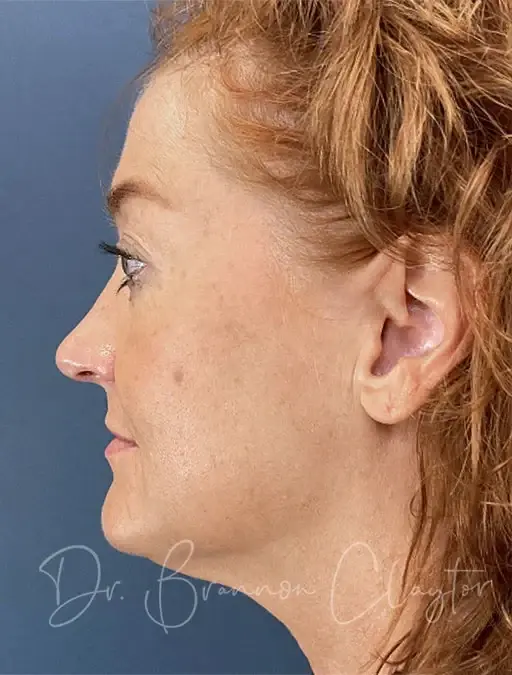 Neck Lift before at Claytor Noone Plastic Surgery: Dr. R. Brannon Claytor in Bryn Mawr, PA