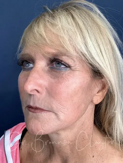 Facelift after at Claytor Noone Plastic Surgery: Dr. R. Brannon Claytor in Bryn Mawr, PA
