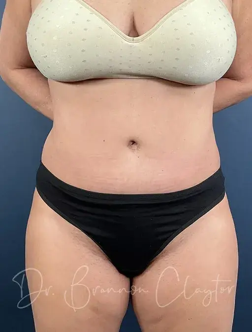 Mini Tummy Tuck after at Claytor Noone Plastic Surgery: Dr. R. Brannon Claytor in Bryn Mawr, PA