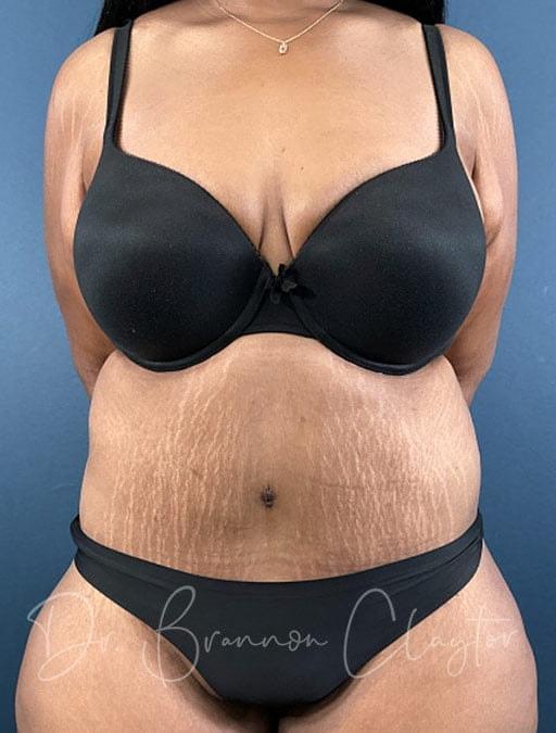 Arm Lift after at Claytor Noone Plastic Surgery: Dr. R. Brannon Claytor in Bryn Mawr, PA