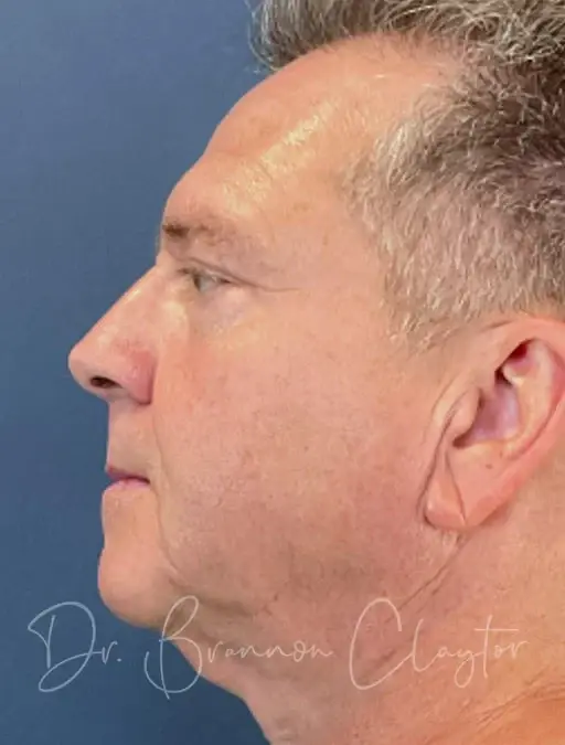 Blepharoplasty after at Claytor Noone Plastic Surgery: Dr. R. Brannon Claytor in Bryn Mawr, PA