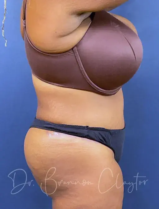Brazilian Butt Lift after at Claytor Noone Plastic Surgery: Dr. R. Brannon Claytor in Bryn Mawr, PA