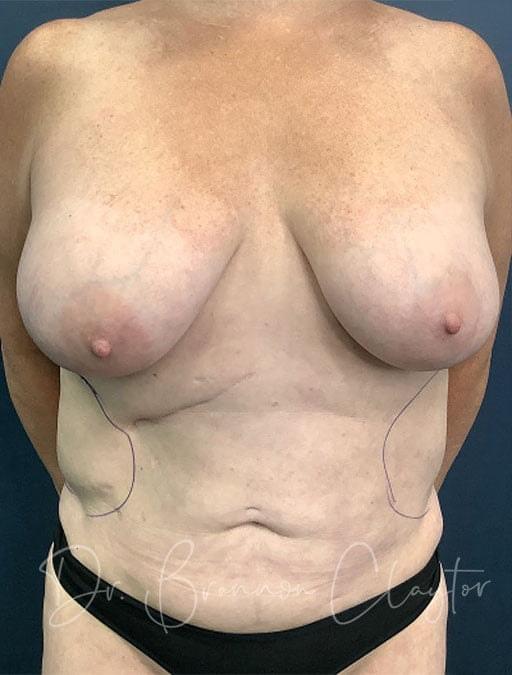 Breast Lift before at Claytor Noone Plastic Surgery: Dr. R. Brannon Claytor in Bryn Mawr, PA