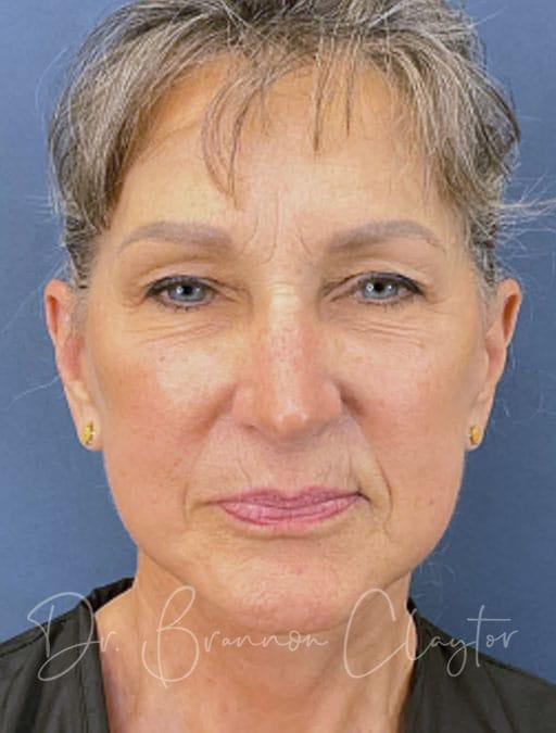 Facelift after at Claytor Noone Plastic Surgery: Dr. R. Brannon Claytor in Bryn Mawr, PA