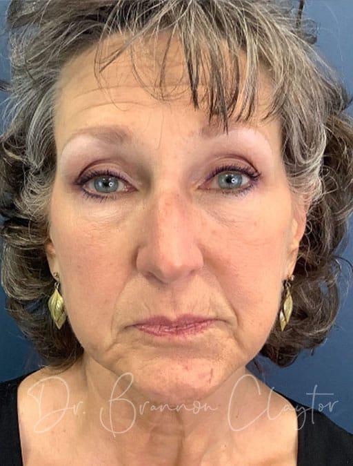 Facelift before at Claytor Noone Plastic Surgery: Dr. R. Brannon Claytor in Bryn Mawr, PA