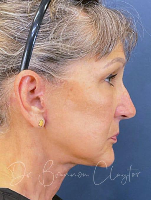 Facelift after at Claytor Noone Plastic Surgery: Dr. R. Brannon Claytor in Bryn Mawr, PA