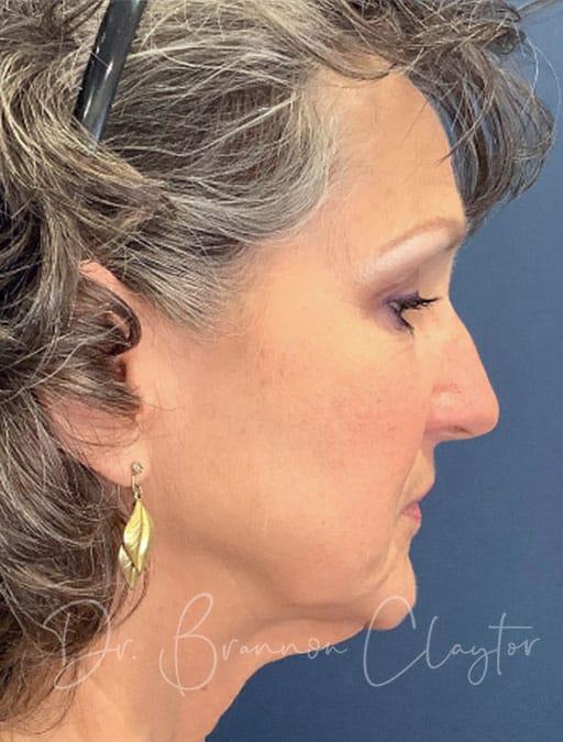 Facelift before at Claytor Noone Plastic Surgery: Dr. R. Brannon Claytor in Bryn Mawr, PA