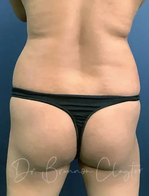 Brazilian Butt Lift before at Claytor Noone Plastic Surgery: Dr. R. Brannon Claytor in Bryn Mawr, PA