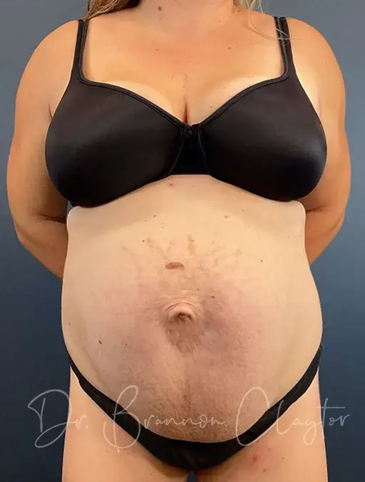 Mommy Makeover before at Claytor Noone Plastic Surgery: Dr. R. Brannon Claytor in Bryn Mawr, PA