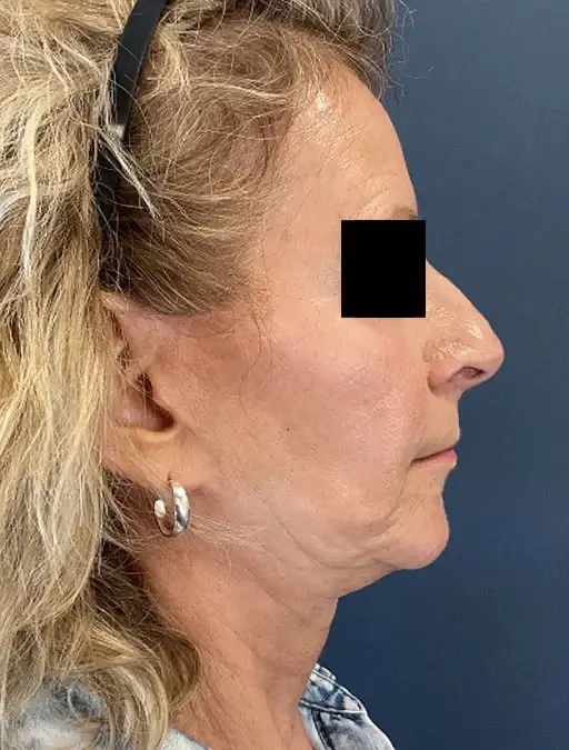 Neck Lift before at Claytor Noone Plastic Surgery: Dr. R. Brannon Claytor in Bryn Mawr, PA
