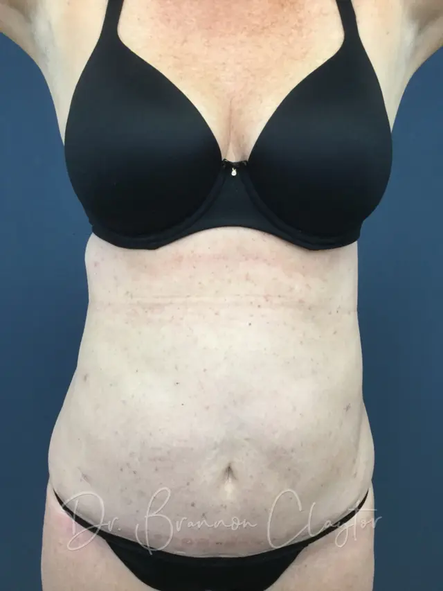 Liposuction after at Claytor Noone Plastic Surgery: Dr. R. Brannon Claytor in Bryn Mawr, PA