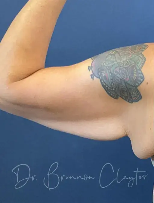 CoolSculpting before at Claytor Noone Plastic Surgery: Dr. R. Brannon Claytor in Bryn Mawr, PA