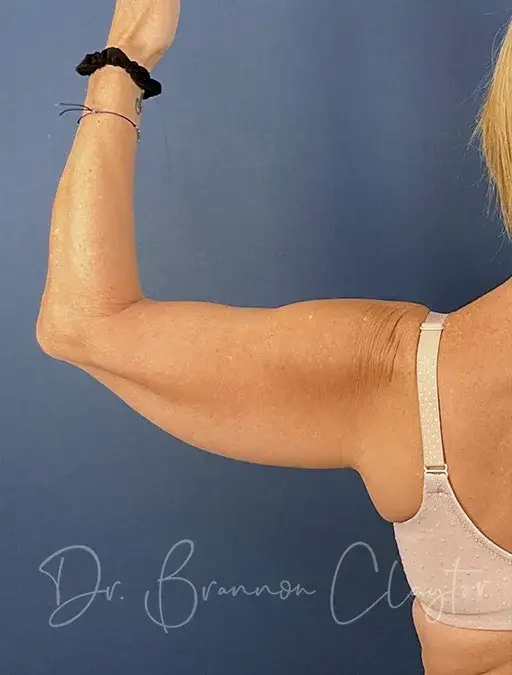 Arm Lift before at Claytor Noone Plastic Surgery: Dr. R. Brannon Claytor in Bryn Mawr, PA