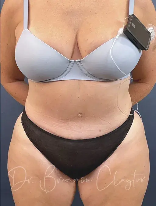 Mini Tummy Tuck after at Claytor Noone Plastic Surgery: Dr. R. Brannon Claytor in Bryn Mawr, PA