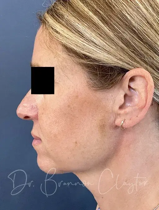 Neck Lift after at Claytor Noone Plastic Surgery: Dr. R. Brannon Claytor in Bryn Mawr, PA