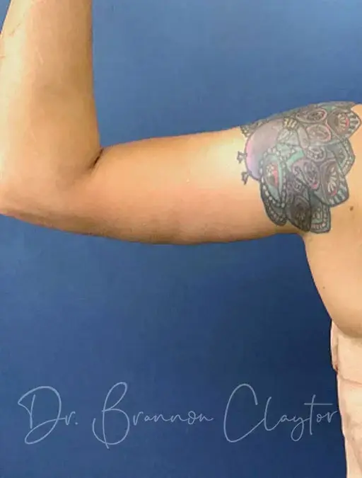 CoolSculpting after at Claytor Noone Plastic Surgery: Dr. R. Brannon Claytor in Bryn Mawr, PA