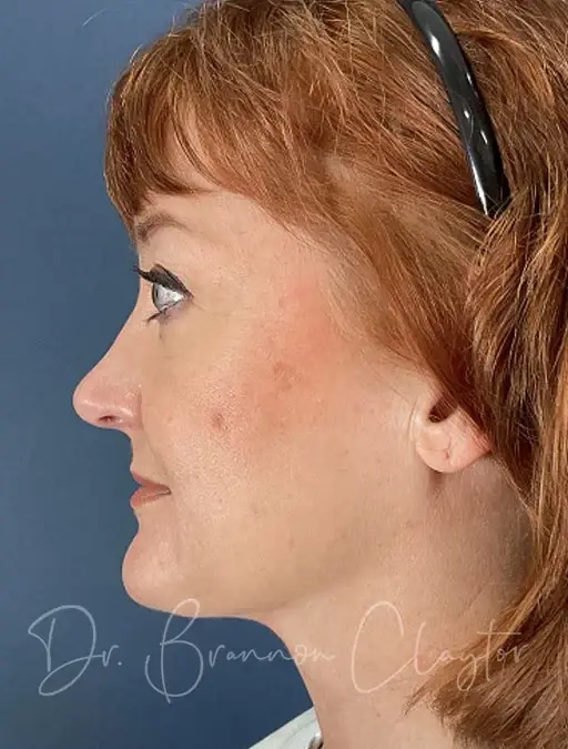Neck Lift after at Claytor Noone Plastic Surgery: Dr. R. Brannon Claytor in Bryn Mawr, PA
